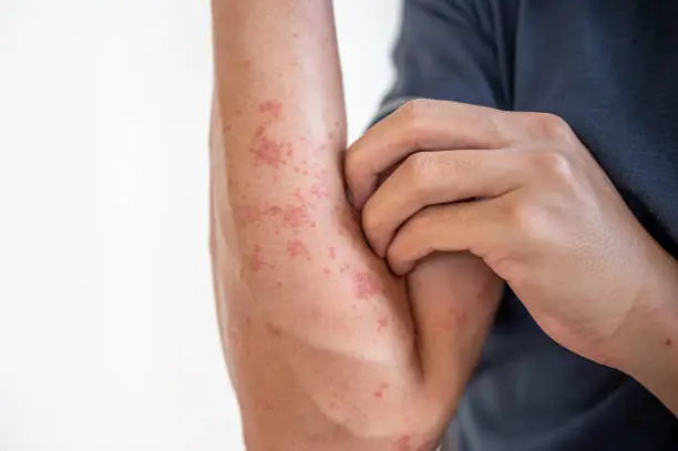 Plaque Psoriasis Tips for Easier Daily Management