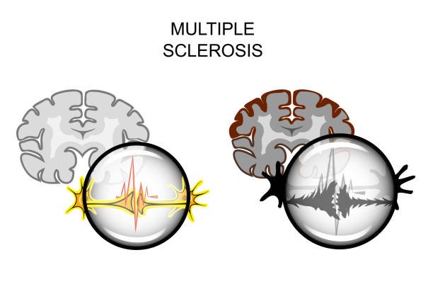 How Multiple Sclerosis Affects the Nervous System: A Deep Look